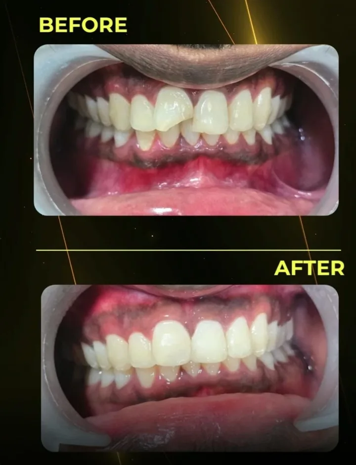Before and after: a chipped upper front tooth rebuilt at The Tooth Corner, Bellandur