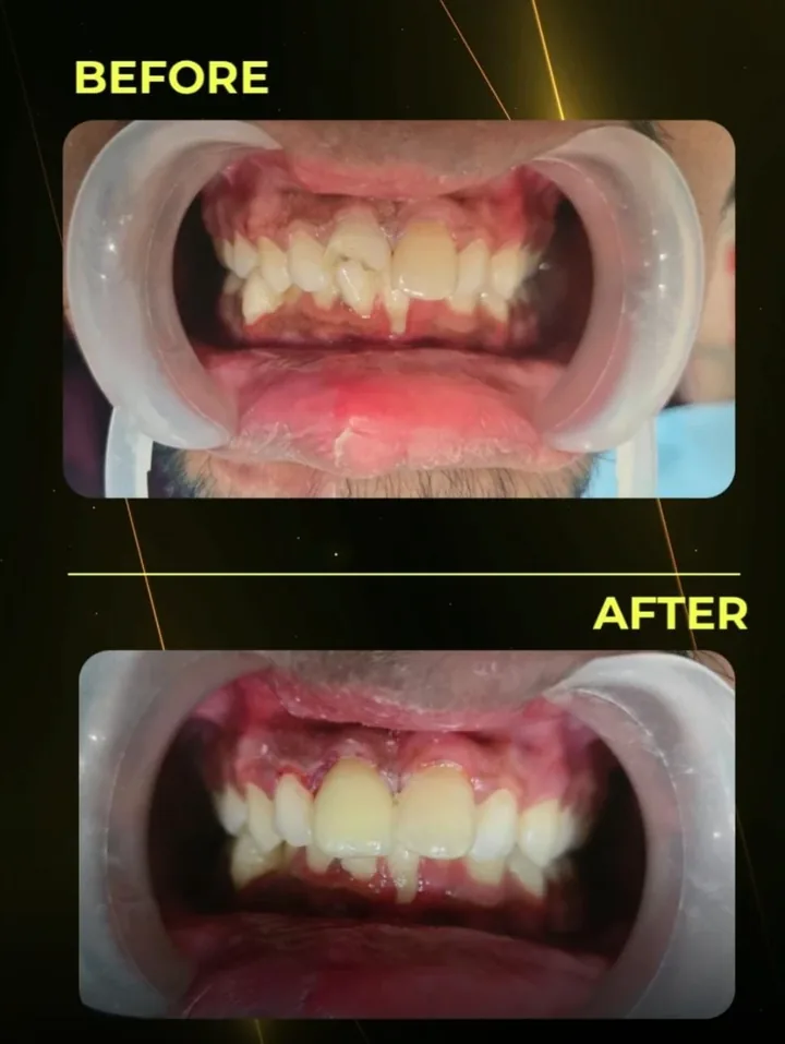 Before and after: overlapping crooked front teeth corrected into an even smile at The Tooth Corner, Bellandur