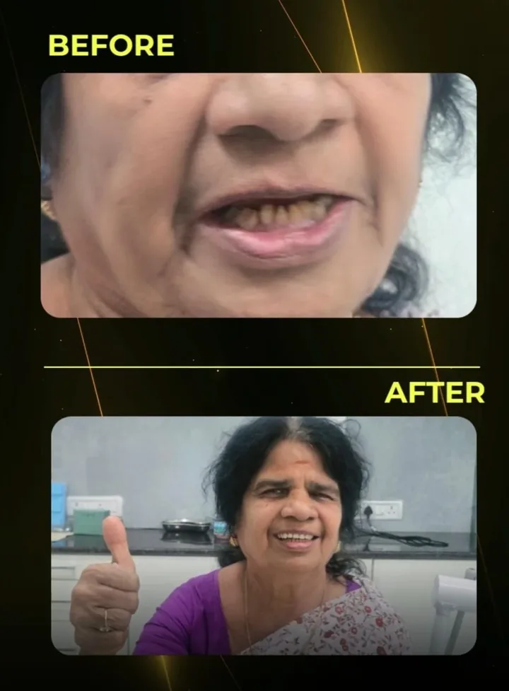 Before and after: an older patient with worn decayed teeth smiling with a complete new smile at The Tooth Corner, Bellandur