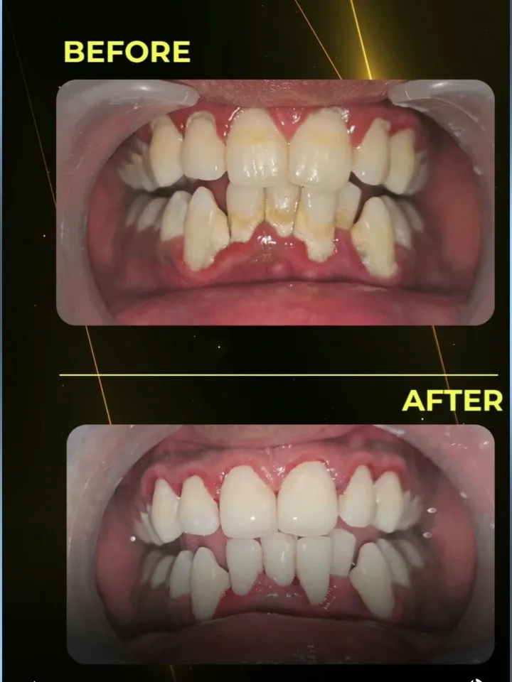 Before and after: heavy tartar and inflamed gums cleaned at The Tooth Corner, Bellandur