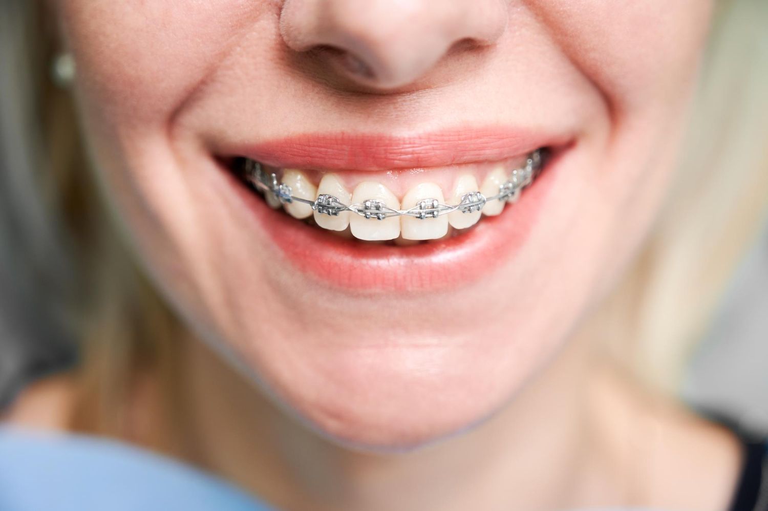 Patient with orthodontic braces smiling during treatment at The Tooth Corner, Bellandur