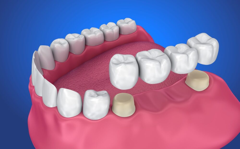Ceramic dental crowns and bridge restorations crafted to match natural teeth at The Tooth Corner, Bellandur