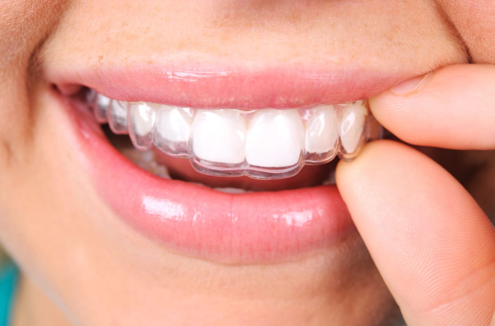 A patient placing a clear Invisalign aligner over their teeth at The Tooth Corner, Bellandur