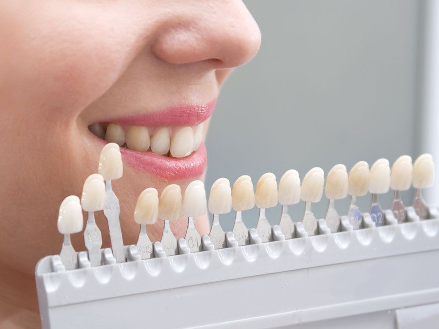 Close-up of a natural-looking smile enhanced with porcelain veneers at The Tooth Corner, Bellandur